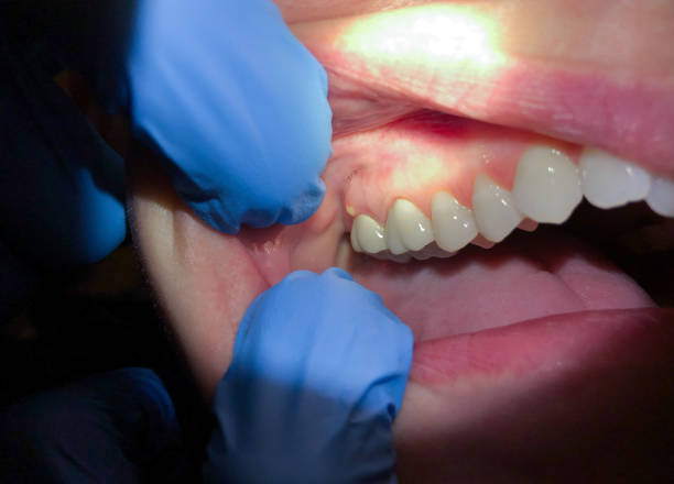 Best Emergency Dental Care for Abscessed Tooth in Gretna, FL